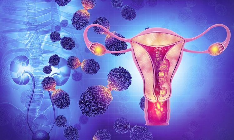 Cervical cancer cost in india