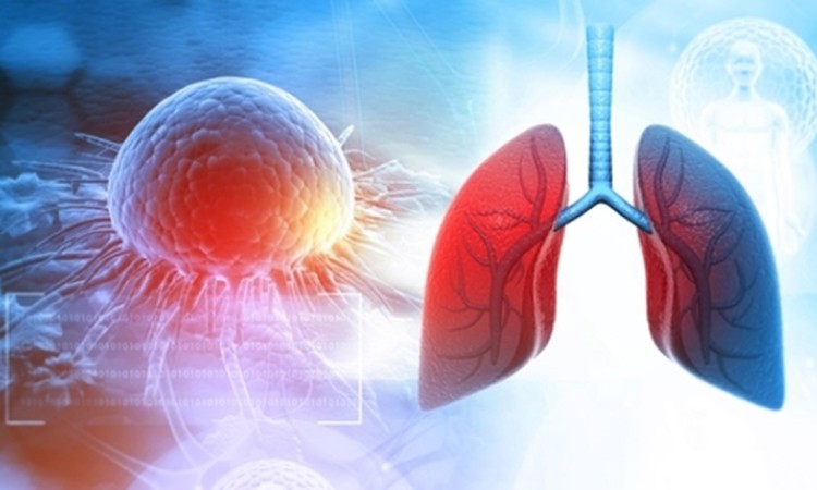 Lung Cancer Treatment Cost in India