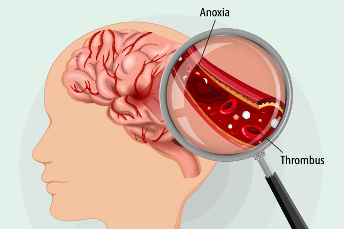 Brain Tumour: Everything You Should Know